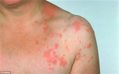 Ross River Rash